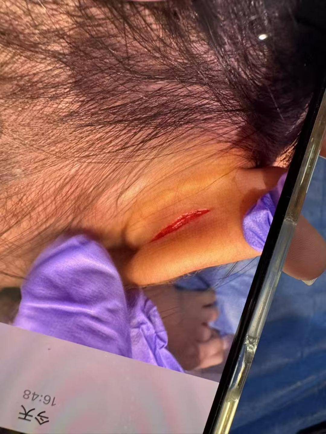 武汉一女童上高端托儿班耳朵疑被撕裂 家长:院方说监控坏了